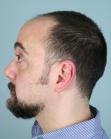 Before Hair Transplant&nbsp;Front